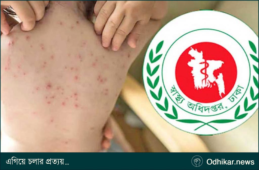 ২৪ ঘণ্টায় হাম উপসর্গে চারজনের মৃত্যু