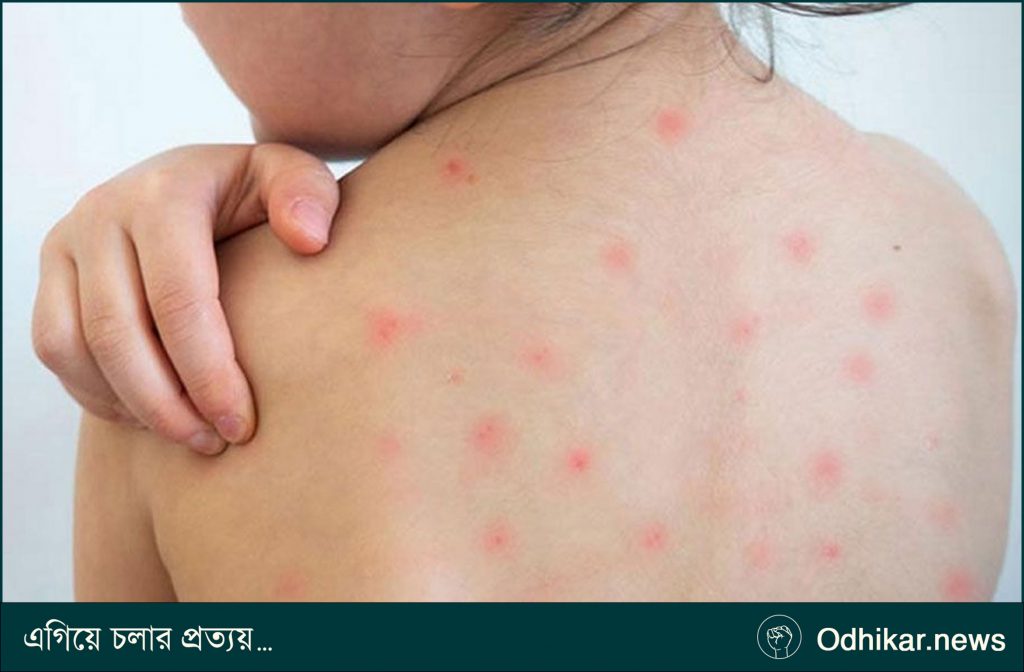 হাম উপসর্গে আরও পাঁচজনের মৃত্যু